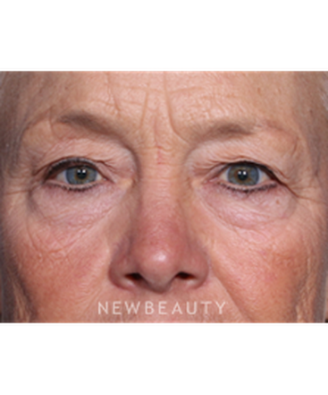 ljcsc-dr-smoot-eyelift-b