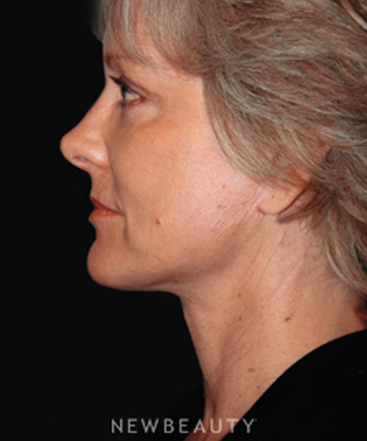 dr-brent-smith-combined-procedures-b