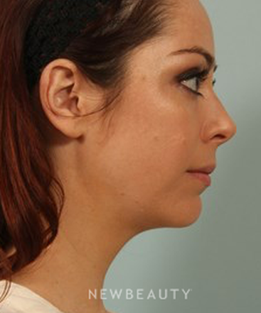 dr-kenneth-beer-kybella-b