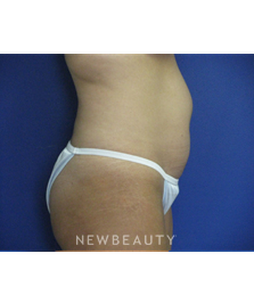 dr-joseph-russo-liposuction-b