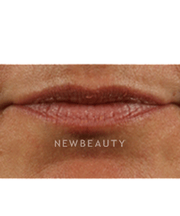 dr-marina-peredo-lip-augmentation-b