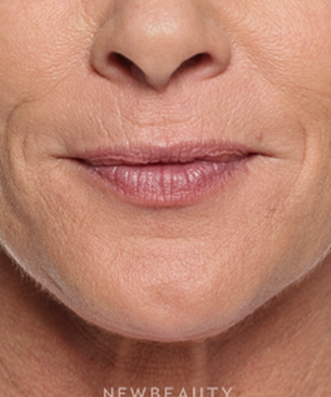 dr-marina-peredo-lip-enhancement-b