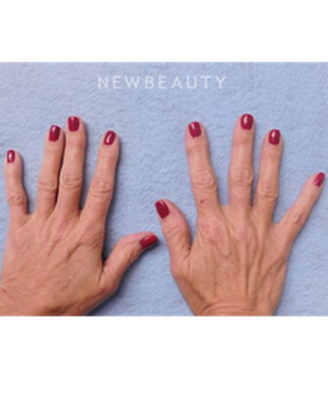 dr-kenneth-beer-injectables-and-fillers-b