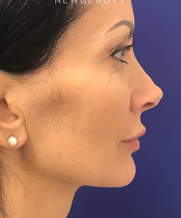 dr-dilip-madnani-minilift-injectables-b