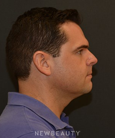 dr-janet-allenby-kybella-b