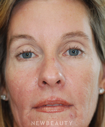dr-kenneth-beer-injectables-fillers-ipl-lasers-b