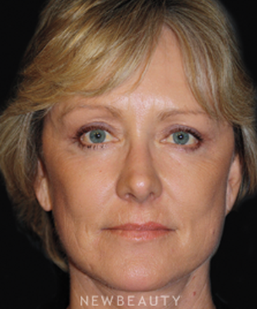 dr-brent-smith-blepharoplasty-facelift-lasers-b
