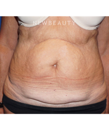 dr-niki-christopoulos-tummy-tuck-b
