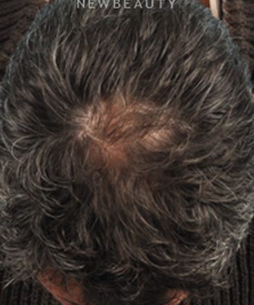 dr-bradley-bengtson-hair-loss-treatment-b
