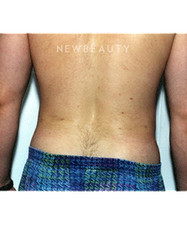 dr-david-rapaport-liposuction-b