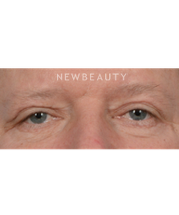 dr-jeffrey-b-wise-upper-blepharoplasty-b