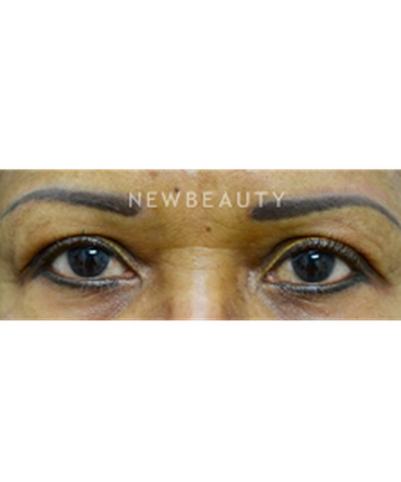 dr-baljeet-k-purewal-blepharoplasty-b