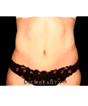 dr-sanjay-grover-tummy-tuck-b