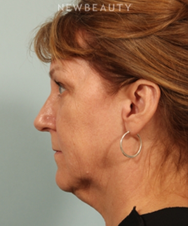dr-kenneth-beer-kybella-b