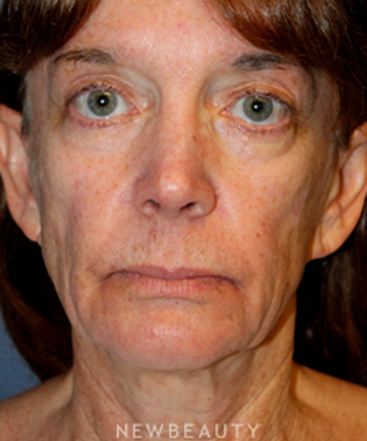 dr-brent-j-smith-facelift-with-fat-transfer-b