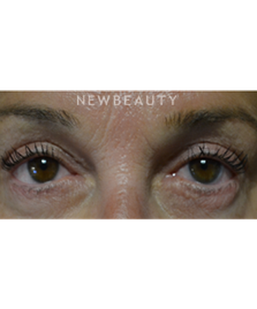 dr-baljeet-k-purewal-blepharoplasty-b