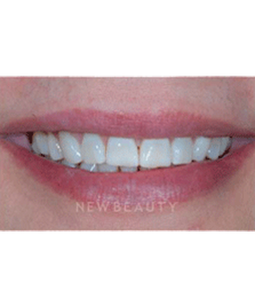 dr-guy-lewis-veneers-b