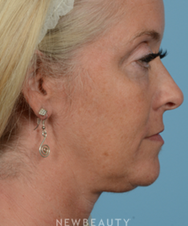 dr-jeffrey-wise-lower-facelift-b
