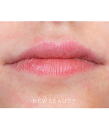 dr-marina-peredo-lip-augmentation-b