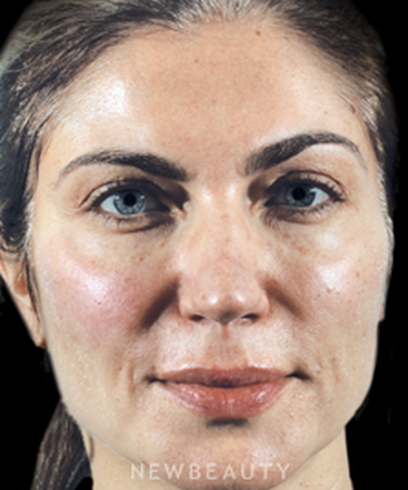 dr-marina-peredo-lip-filler-and-cheek-augmentation-b