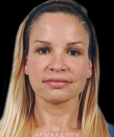 dr-kenneth-beer-injectables-fillers-b