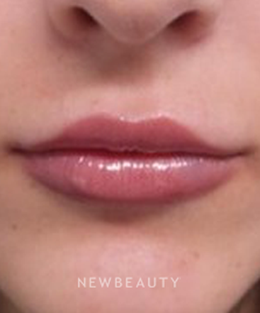 dr-marina-peredo-restylane-silk-b