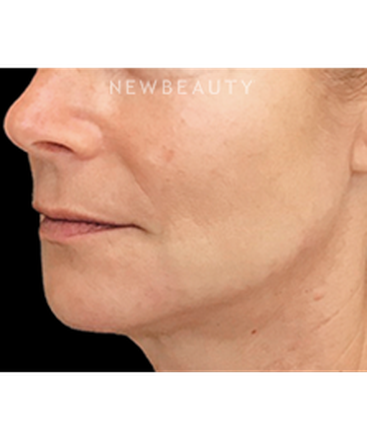 dr-janet-allenby-liquid-facelift-b