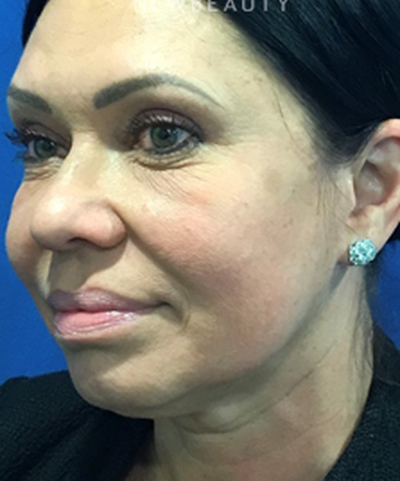 dr-dilip-madnani-facelift-necklift-b