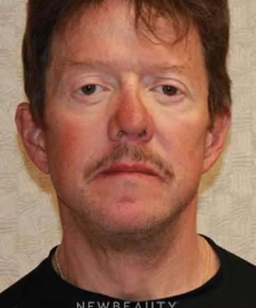 dr-dilip-d-madnani-facelift-necklift-eyelift-b