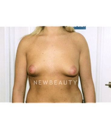 dr-david-rapaport-breast-augmentation-b