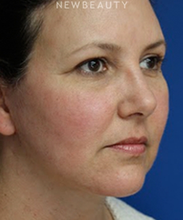 dr-joseph-russo-addressing-facial-aging-face-ebg-b