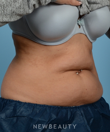 dr-jeffrey-wise-coolsculpting-b