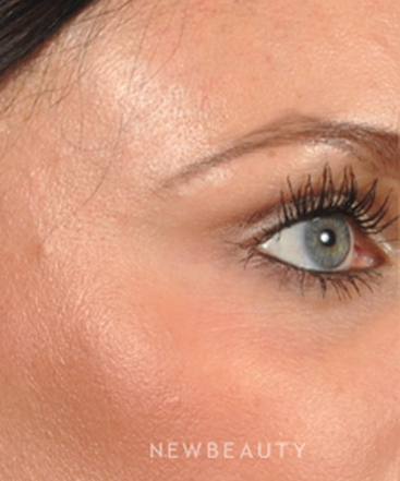 dr-bradley-bengtson-periorbital-vessel-treatment-b