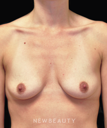 dr-andrew-smith-breast-augmentation-b
