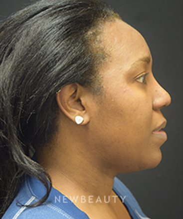 dr-jeffrey-b-wise-lipo-rhinoplasty-b