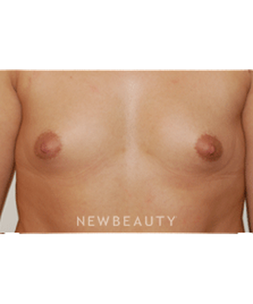 dr-david-rapaport-breast-augmentation-b