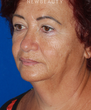 dr-konstantin-vasyukevich-lower-facelift-b