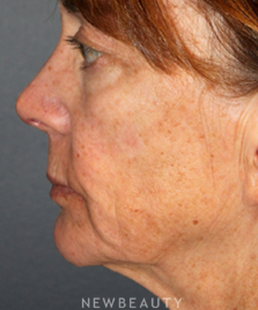 dr-brent-j-smith-facelift-with-fat-transfer-b