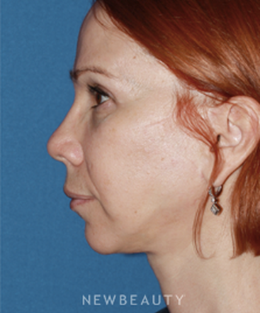 dr-konstantin-vasyukevich-traditional-facelift-b