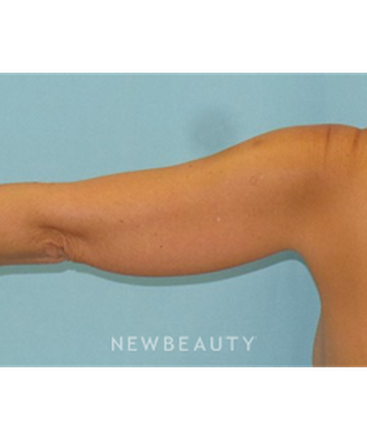 dr-sean-simon-smartlipo-b