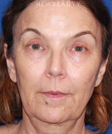 dr-dilip-madnani-facelift-necklift-b