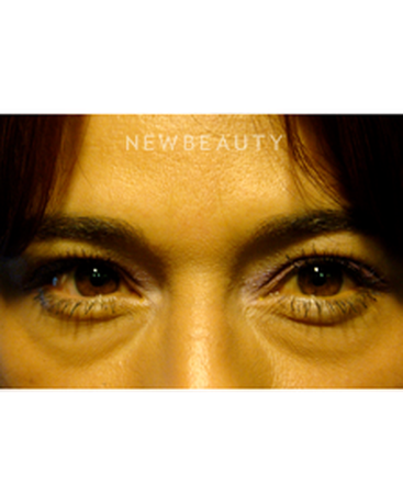 dr-baljeet-k-purewal-lower-blepharoplasty-b