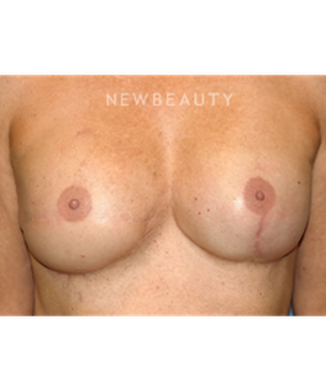 dr-bryan-gawley-breast-reconstruction-b
