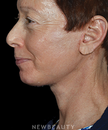 dr-ryan-p-chastant-rejuvenating-results-b