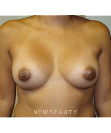 dr-sanjay-grover-breast-augmentation-b