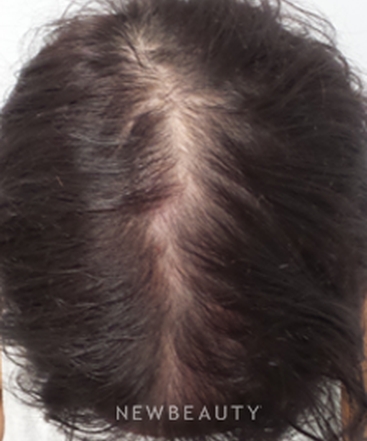 dr-marina-peredo-hair-loss-treatment-b