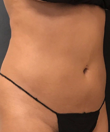 dr-janet-allenby-coolsculpting-b