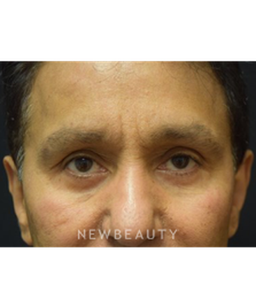 dr-jeffrey-b-wise-lower-blepharoplasty-b