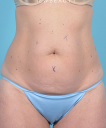dr-bradley-bengtson-coolsculpting-b
