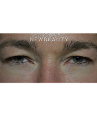 dr-baljeet-k-purewal-upper-blepharoplasty-b
